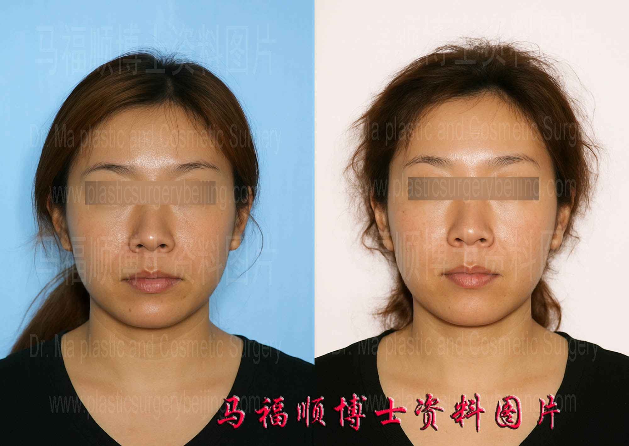 上下颌后推整形人中缩短