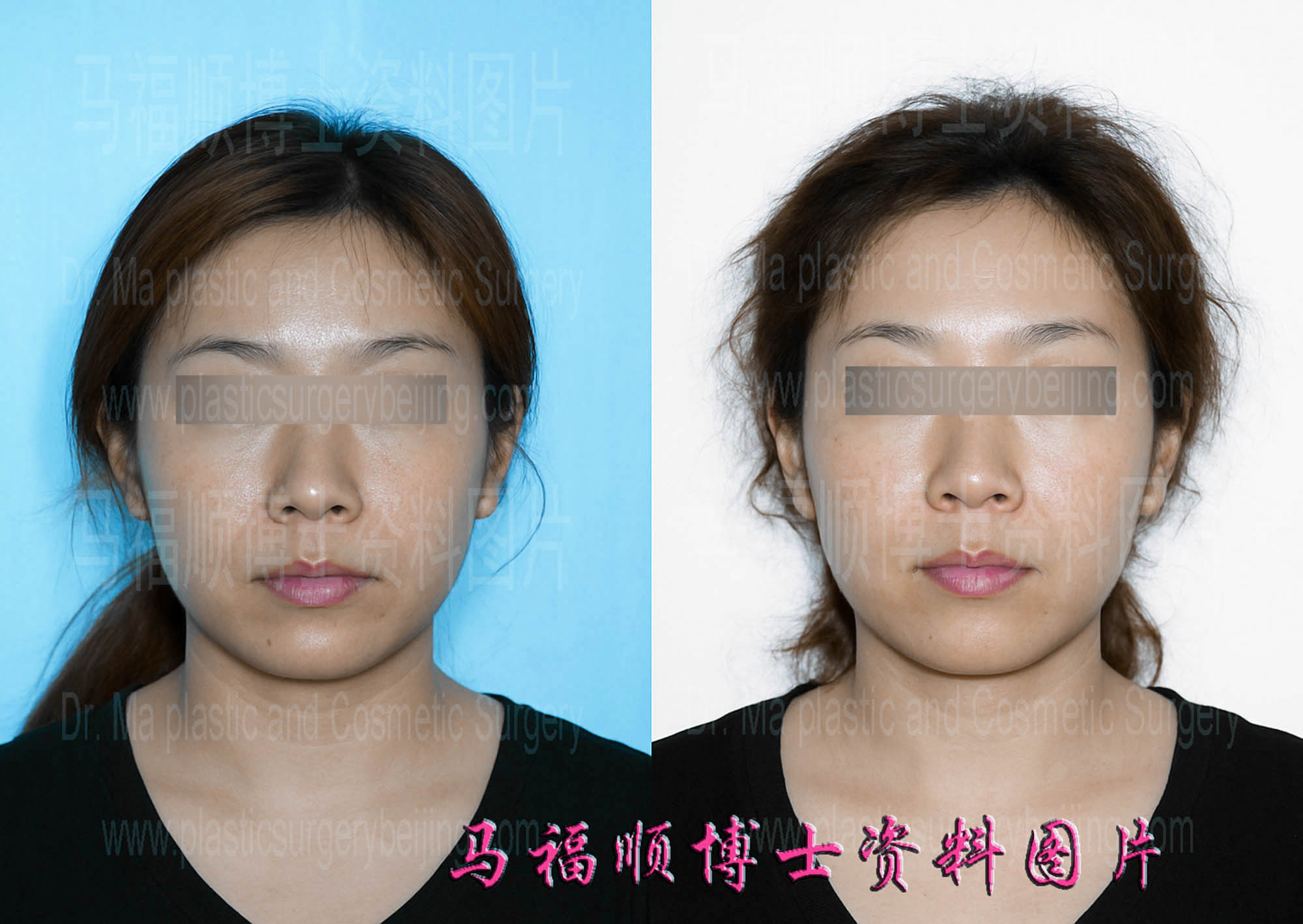 上下颌后推整形人中缩短