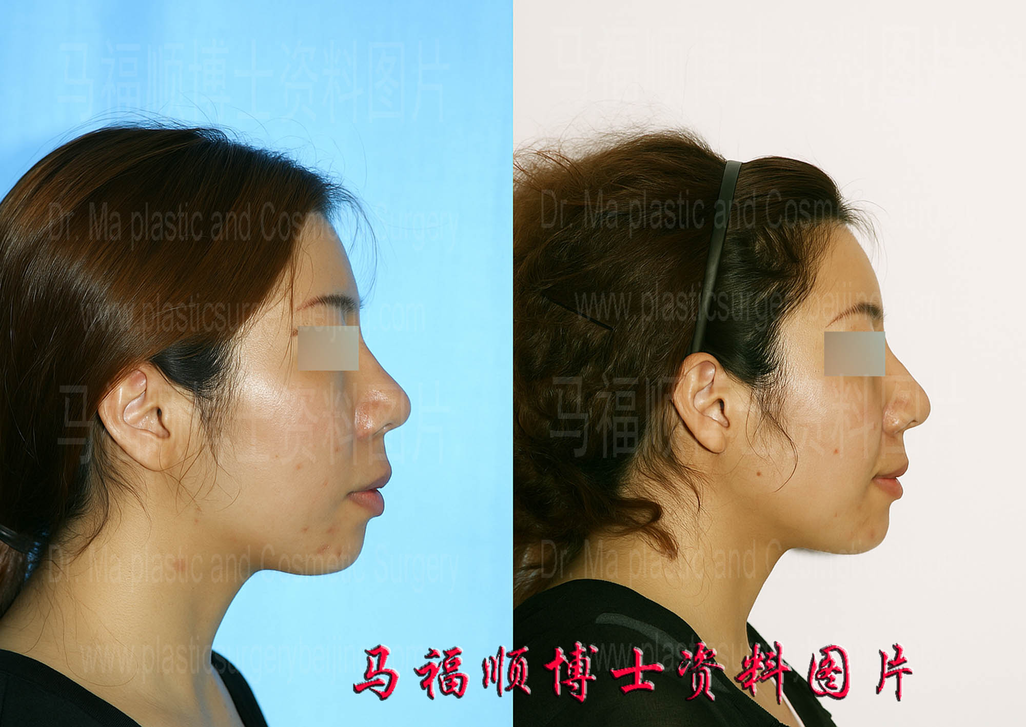 上下颌后推整形人中缩短侧面