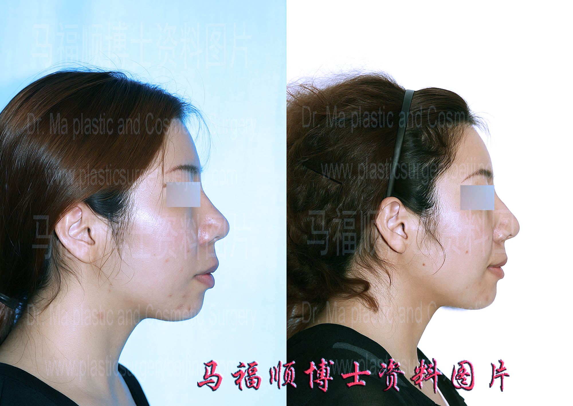 上下颌后推整形人中缩短侧面