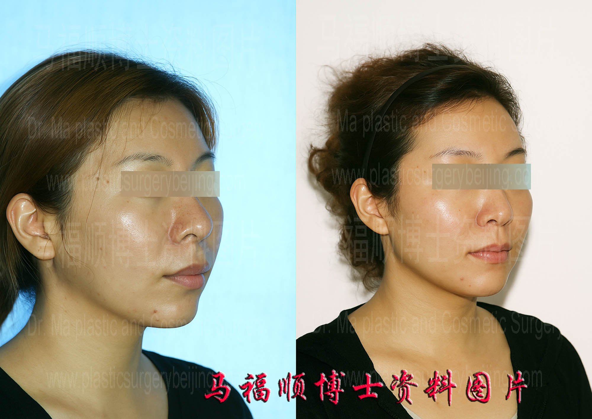 上下颌后推整形人中缩短45度角