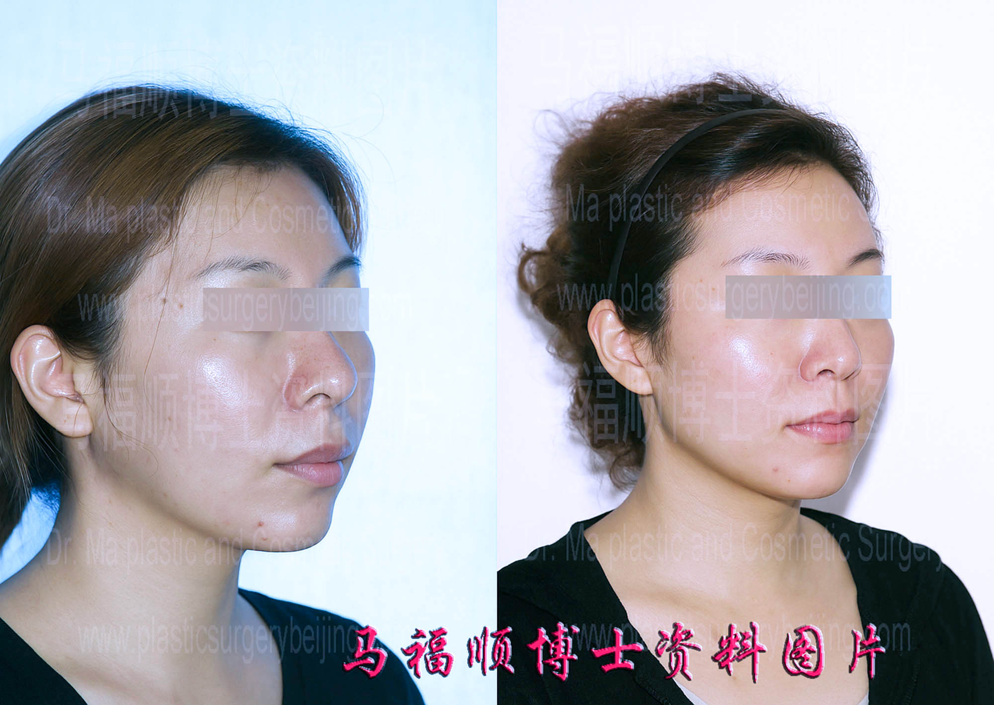 上下颌后推整形人中缩短45度角