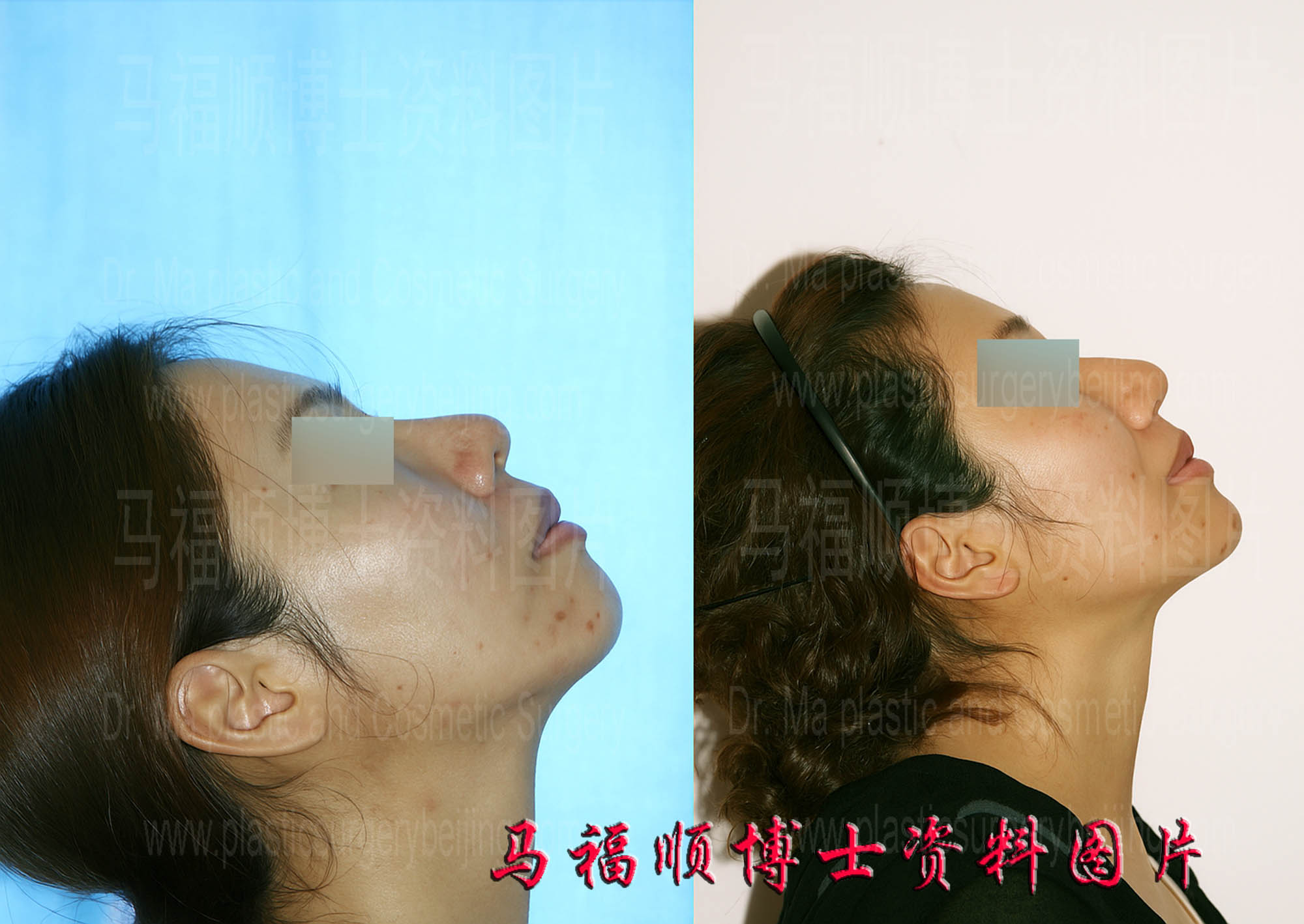 上下颌后推整形人中缩短仰头位