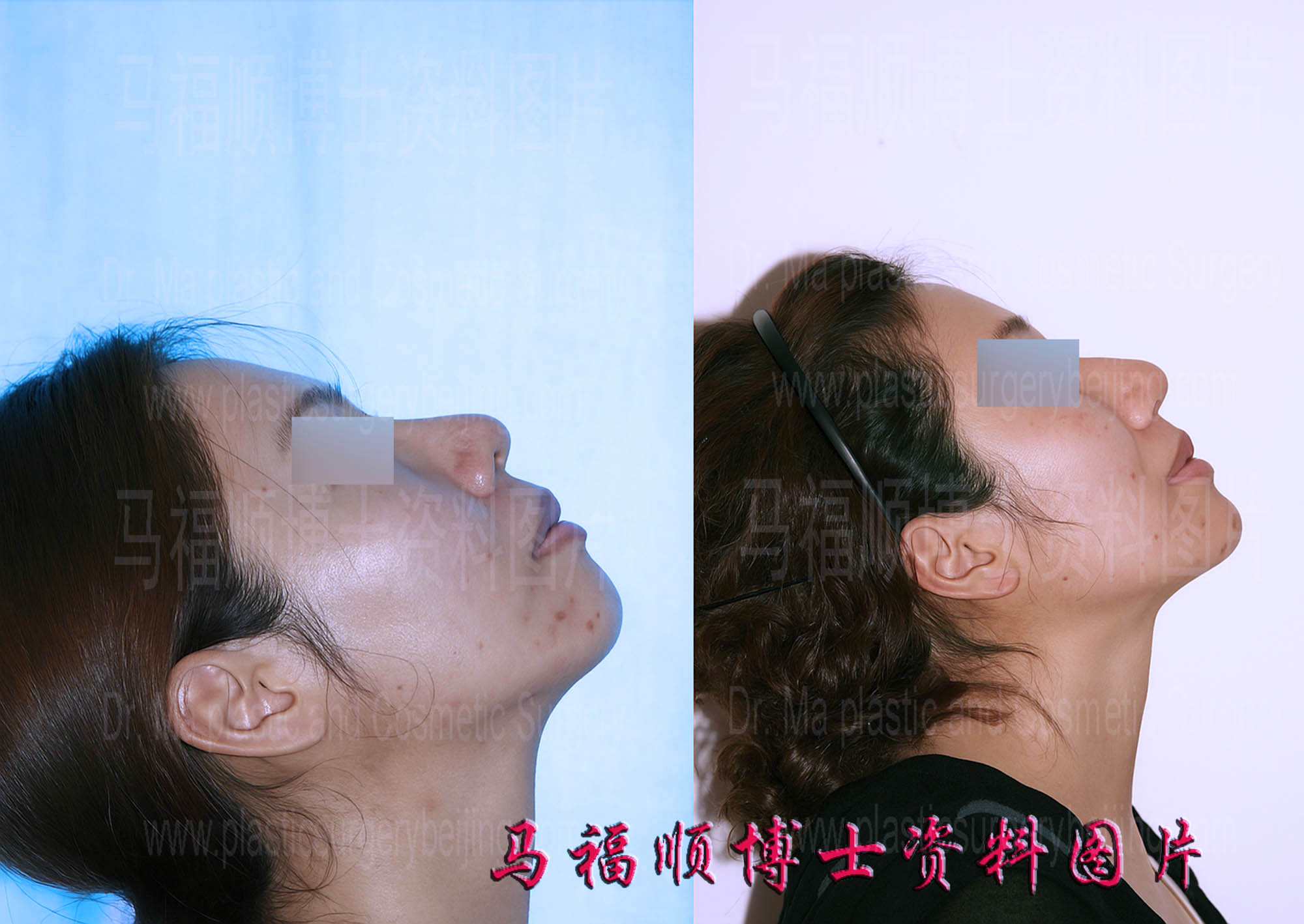 上下颌后推整形人中缩短仰头位