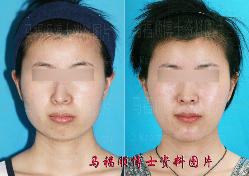 下巴骨前移正面