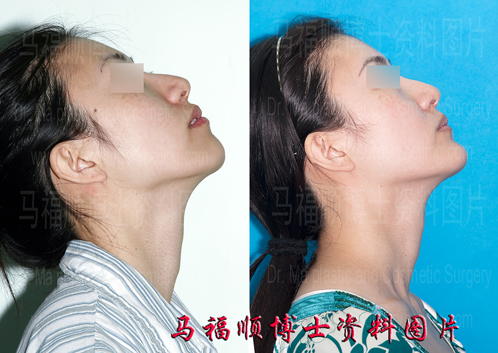 下巴前移仰头位