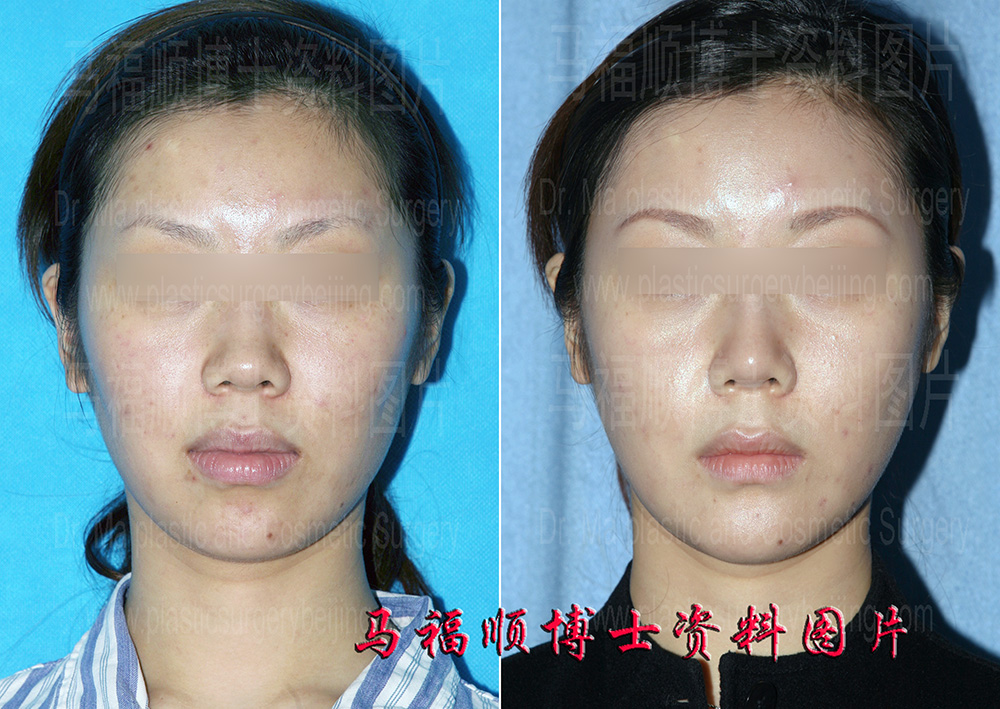 颏前移替代膨体改善小下巴