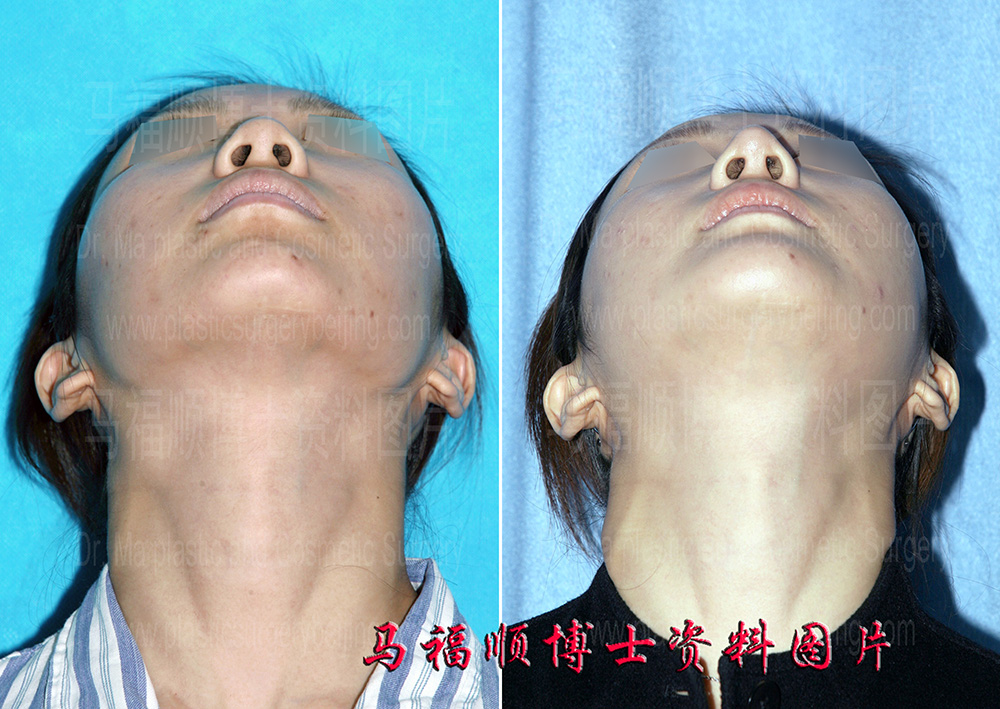 仰头位可以隐约看到膨体的形状