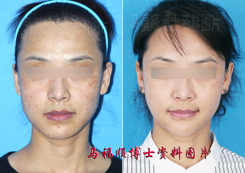 下巴与下颌联合整形