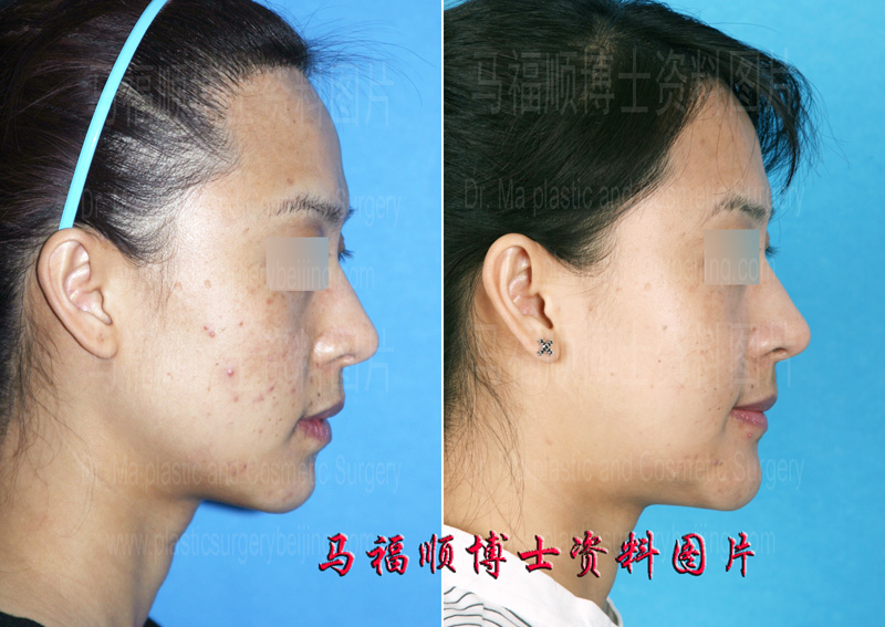 下颌骨整体整形