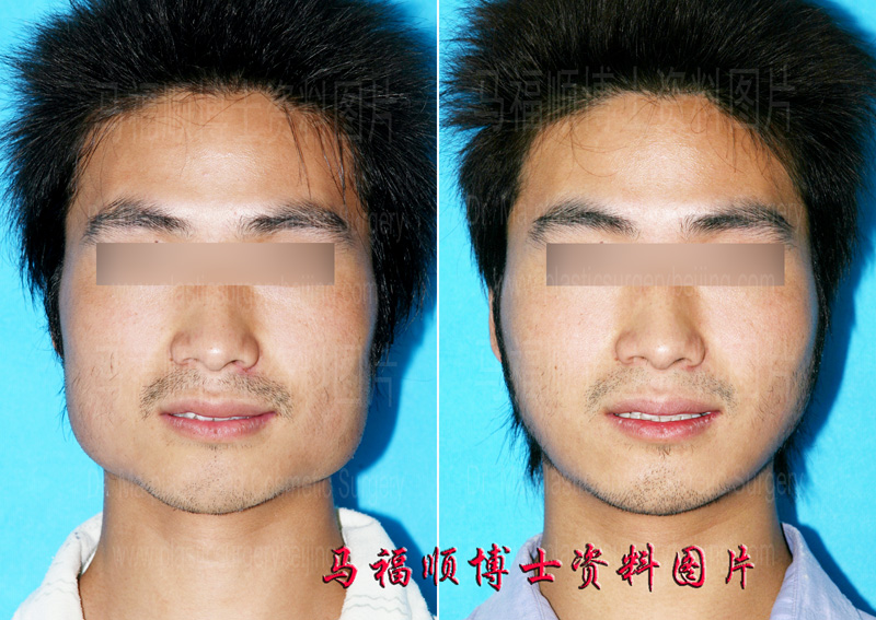 男士下颌骨整形
