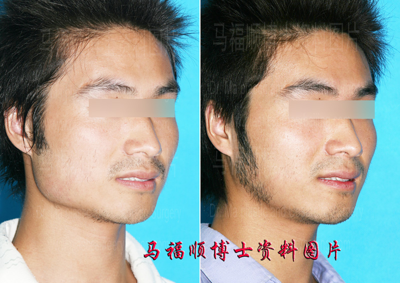 男士下颌角整形