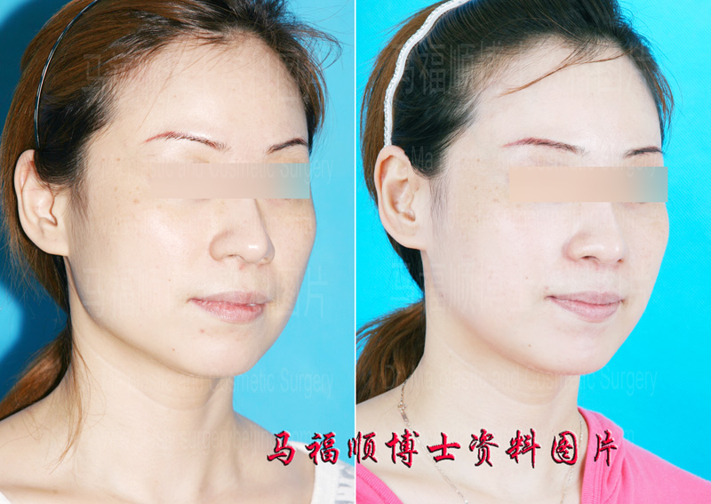 方脸变鸭蛋脸斜位