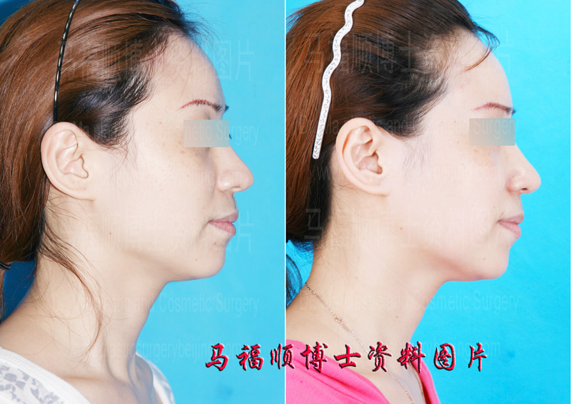 方脸变鸭蛋脸整形