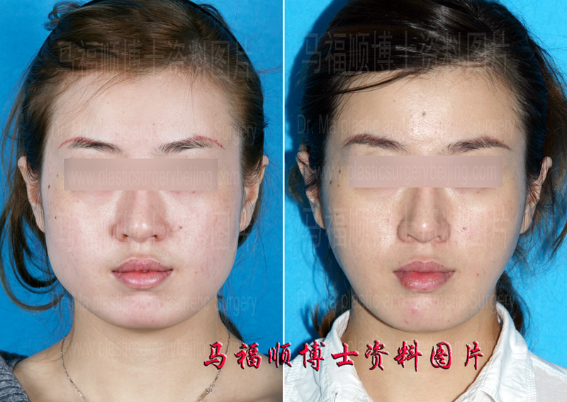 下颌骨缩小咬肌部分切除术