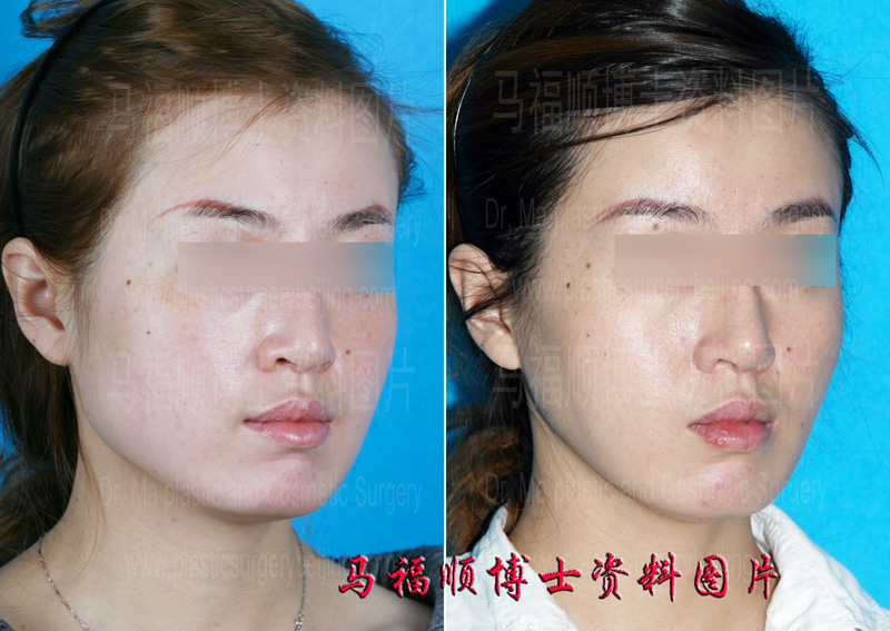 下颌骨缩小整形