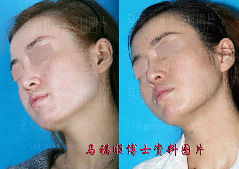 下颌骨整形后下颌缘的变化