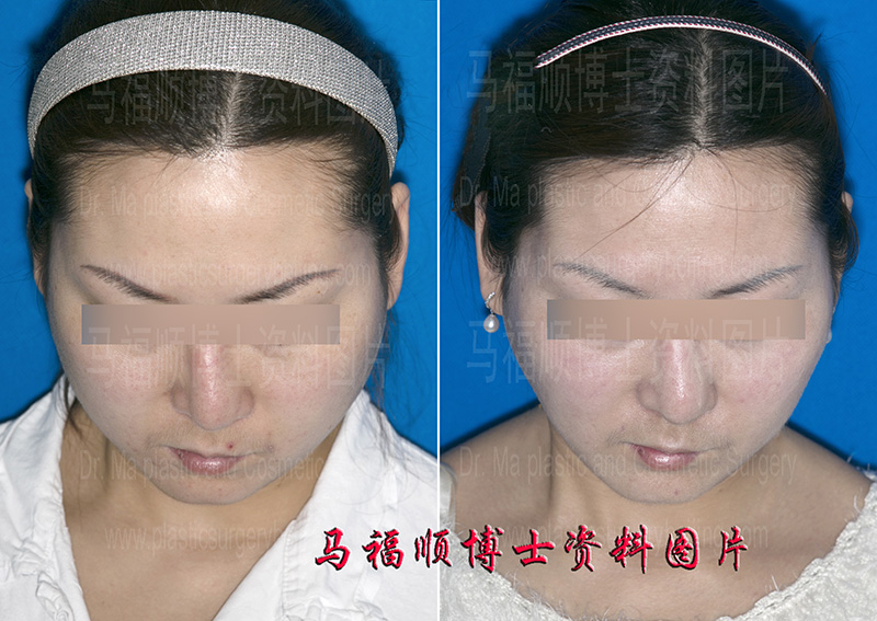 斜颈所致歪脸整形