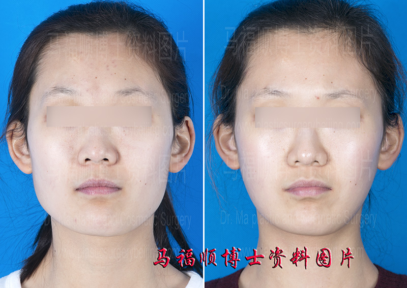 保留下颌角的下颌角整形