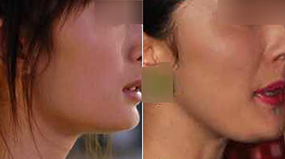 下颌角切除后“马脸”