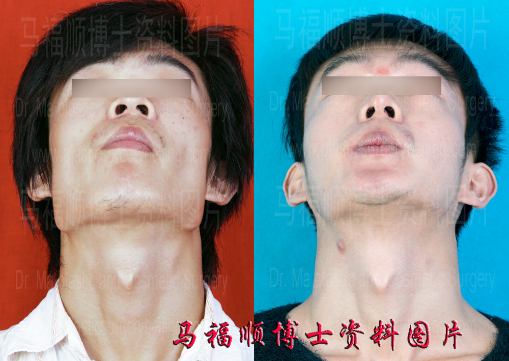 下颌角缩小 下颌角缩小