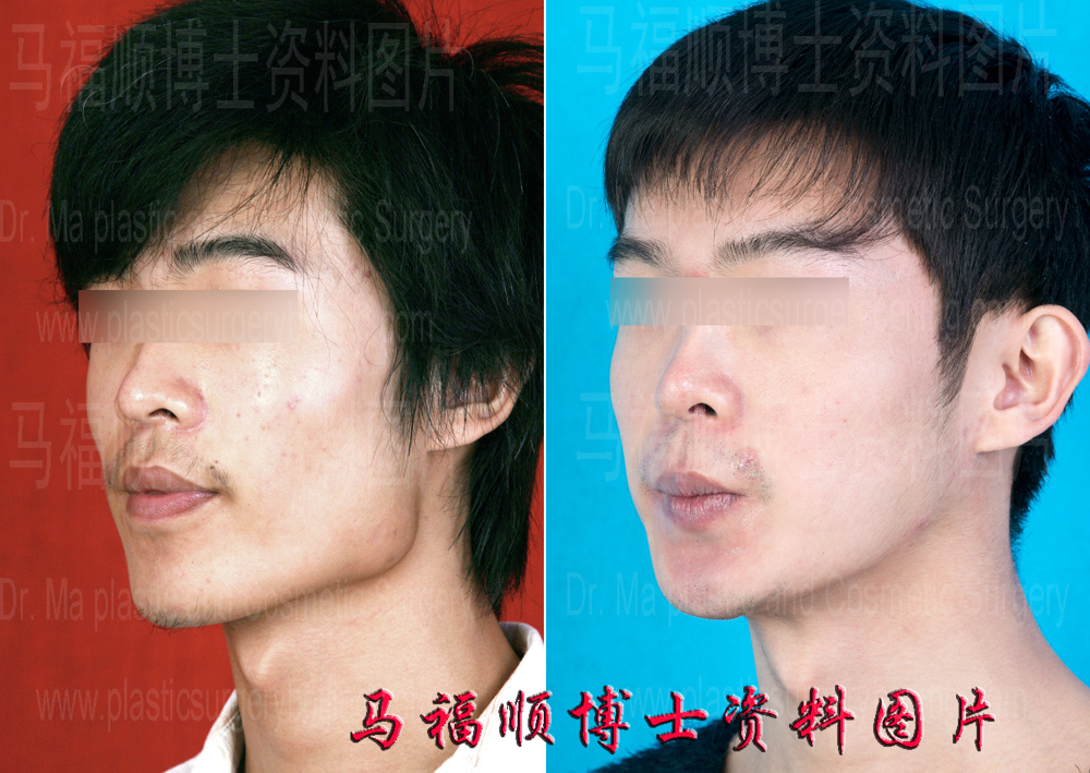 下颌角切除为主的下颌骨缩小 下颌角切除为主的下颌骨缩小