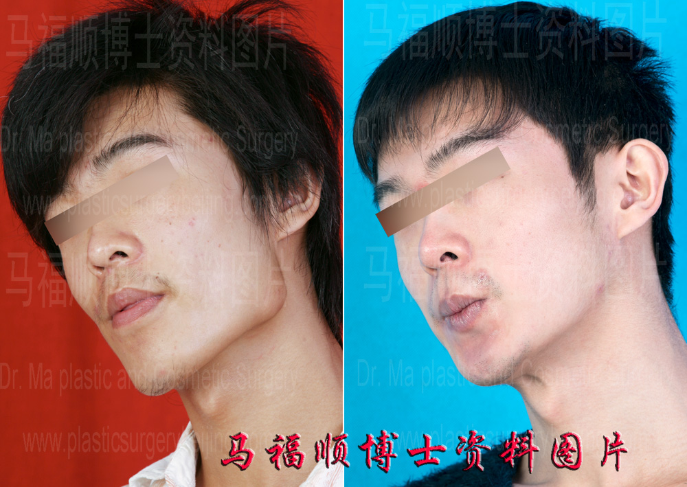 下颌角缩小整形 下颌角缩小整形