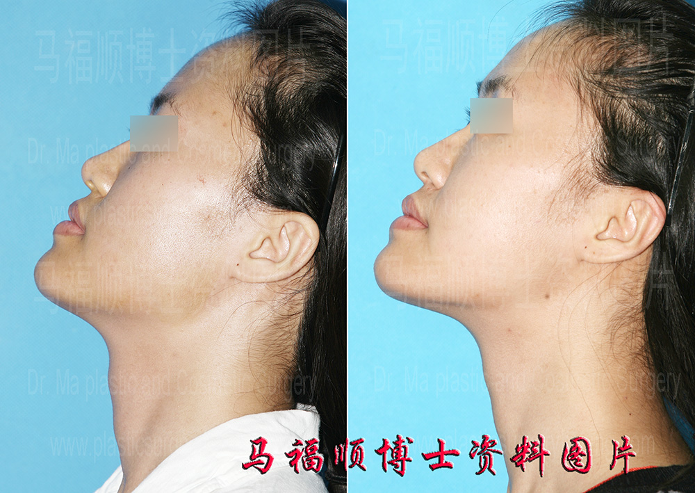 胖脸变小左侧位