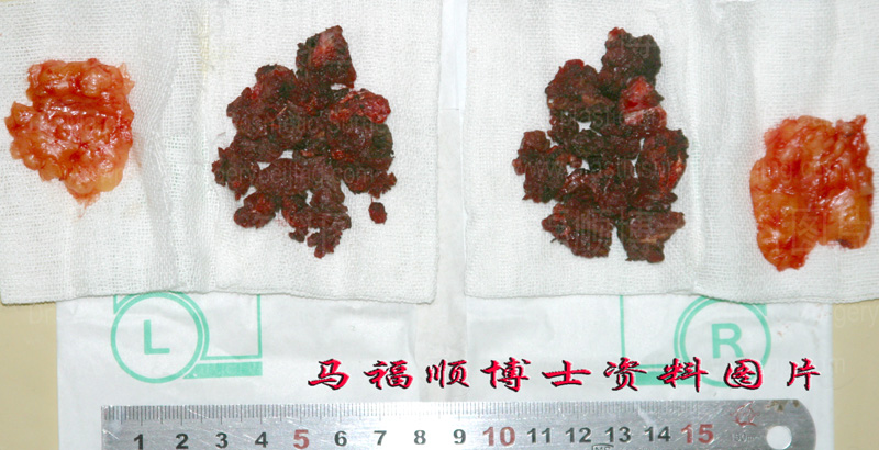 取出的咬肌及颊脂垫