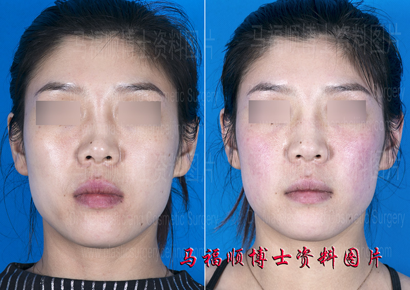 鼻骨外伤早期修复 鼻骨外伤早期修复