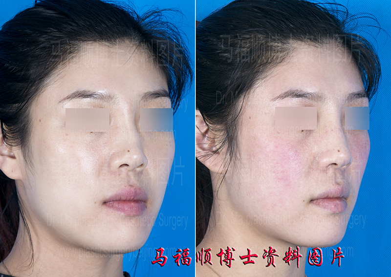 鼻外伤后畸形修复 鼻外伤后畸形修复