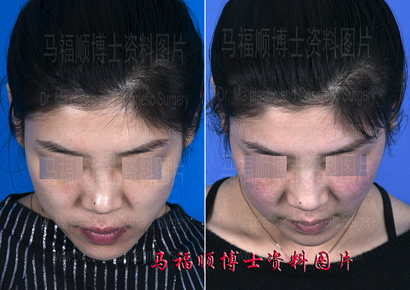 鼻骨骨折修复 鼻骨骨折修复