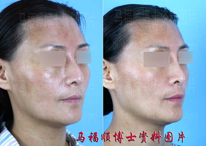 驼峰鼻歪鼻侧位