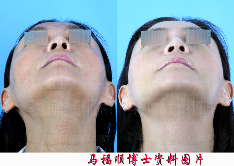 歪鼻整形仰头位