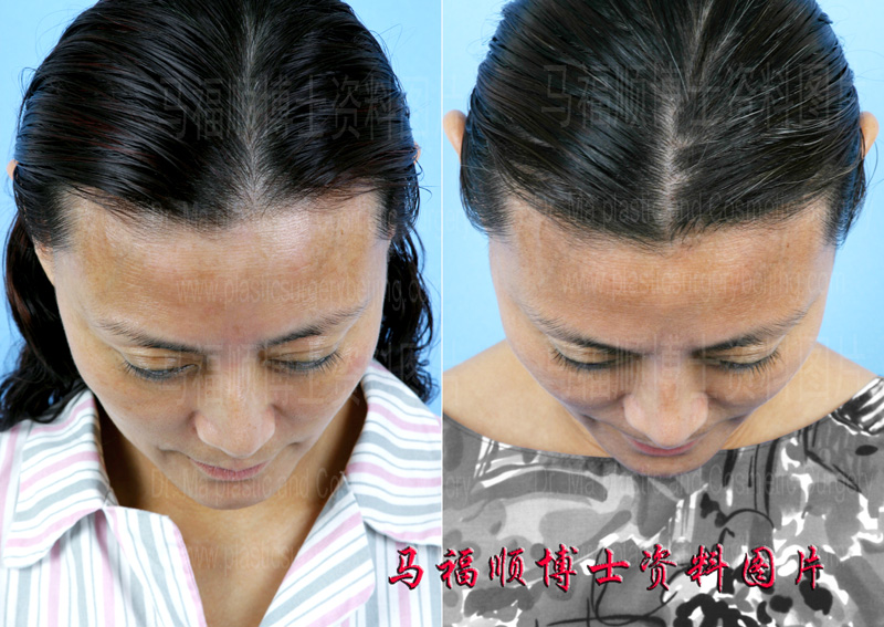 鼻背左侧偏曲畸形矫正