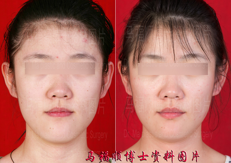 地包天整形前后