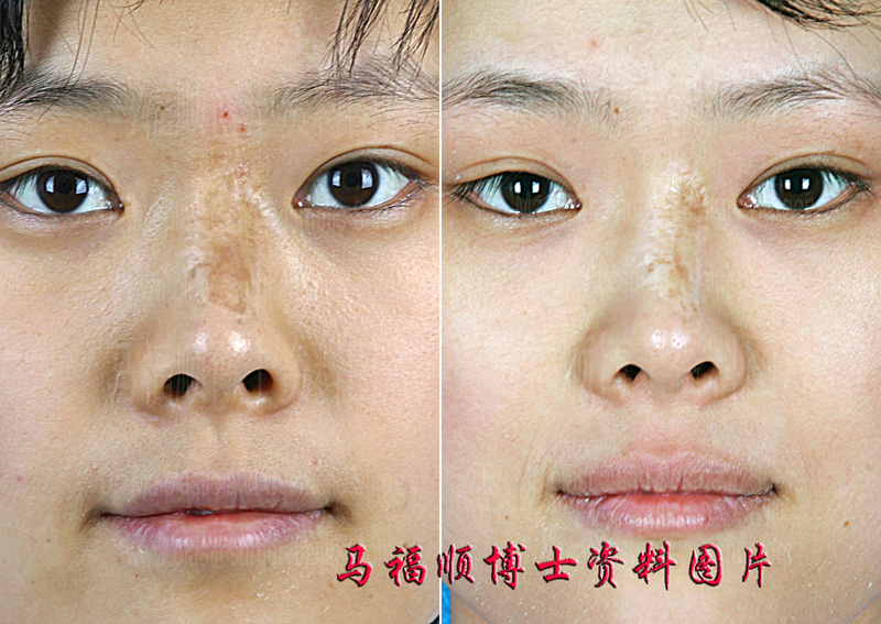 鼻背疤痕分次切除术