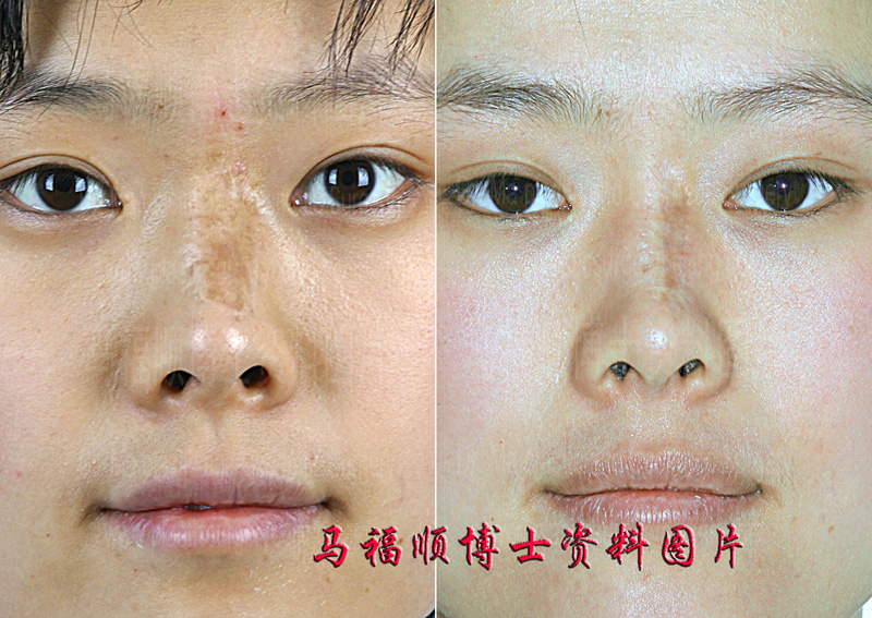鼻背疤痕分次切除2