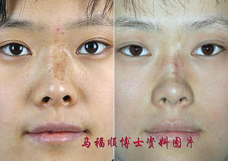 鼻背疤痕分次切除3