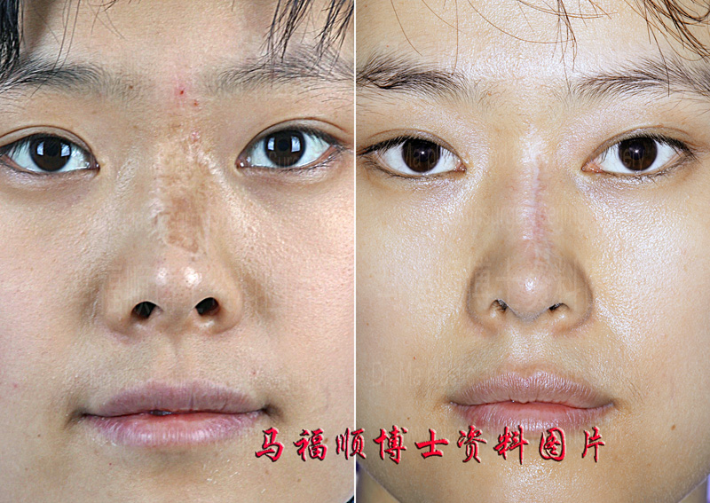 鼻背疤痕分次切除术4