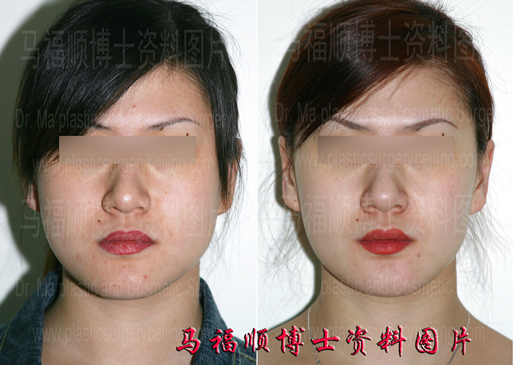 下巴颏缩小后正面对比