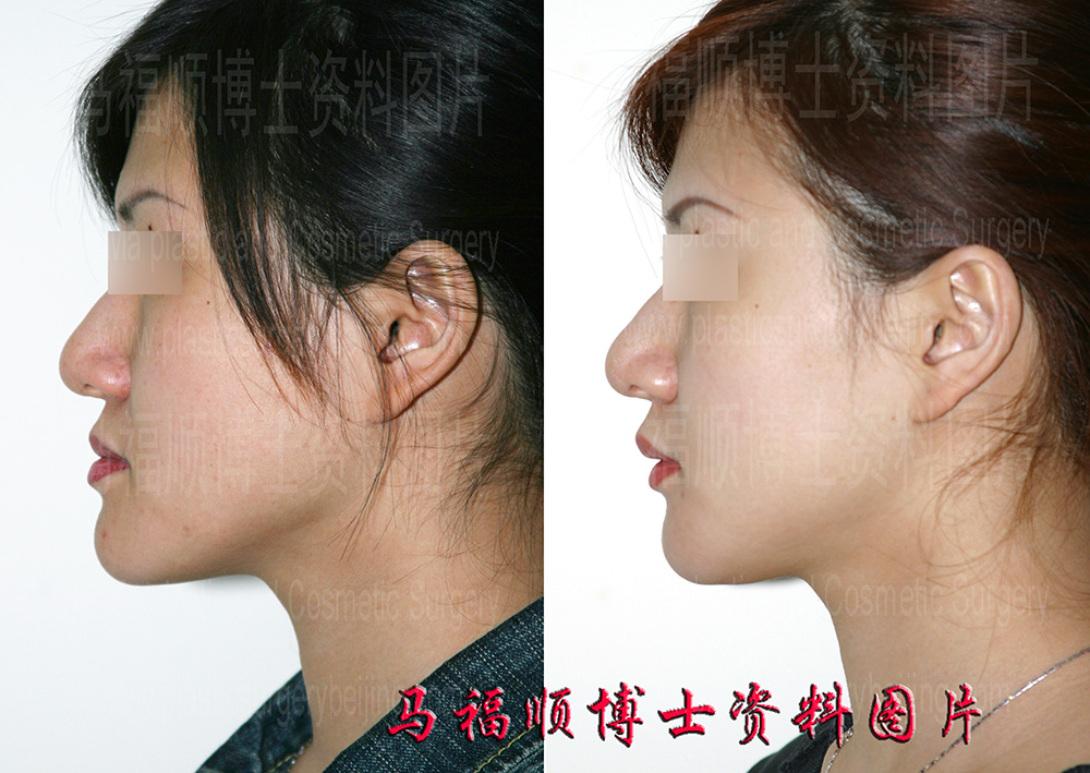 下颌前端楔形截骨