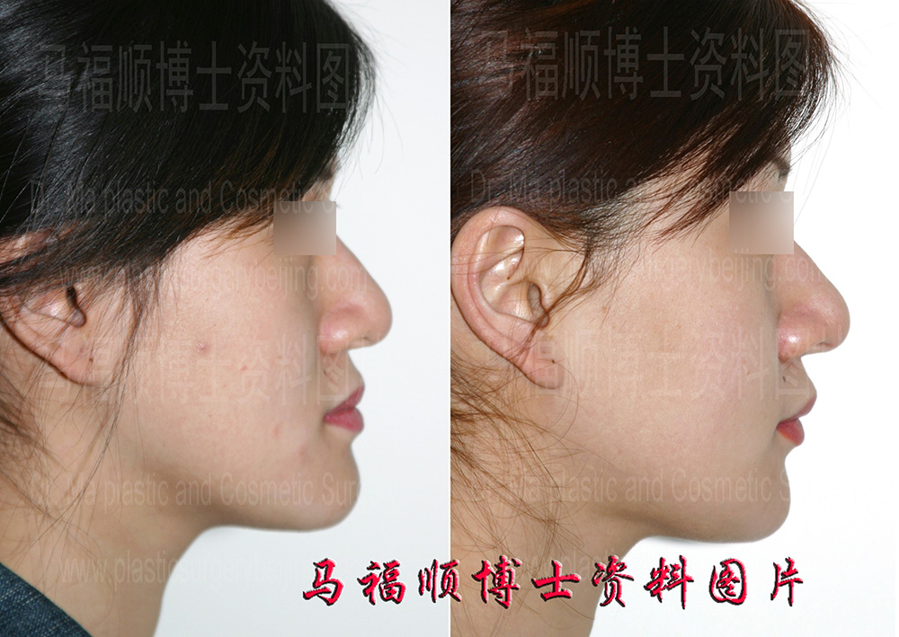 楔形截骨下颌骨缩小