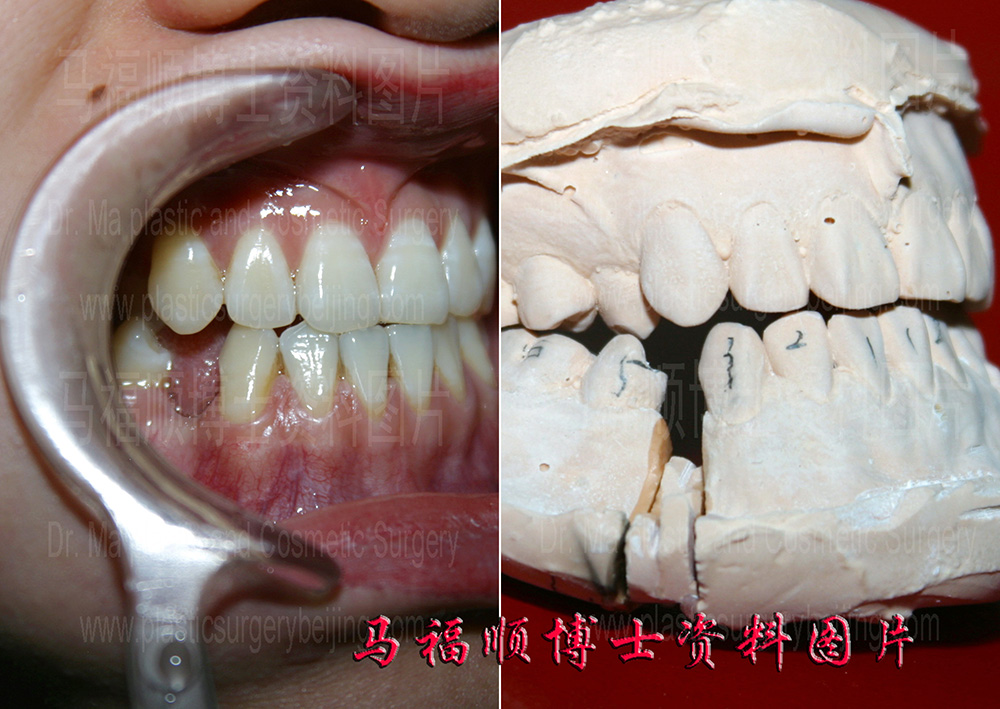 下颌前端截骨示意