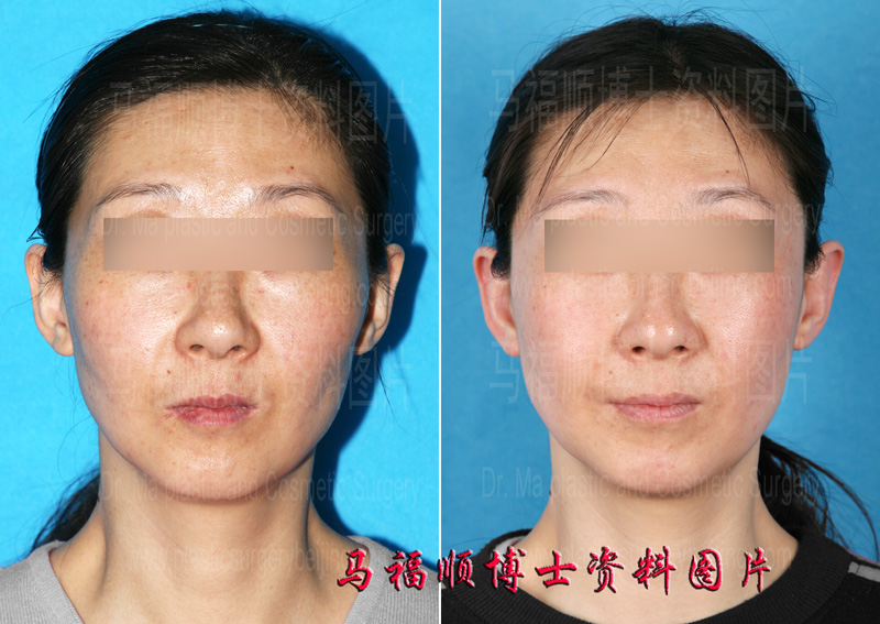 舒平法颧骨颧弓整形