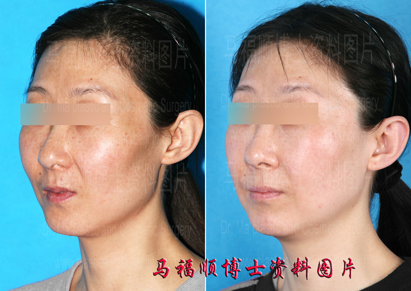 舒平法颧骨颧弓内推