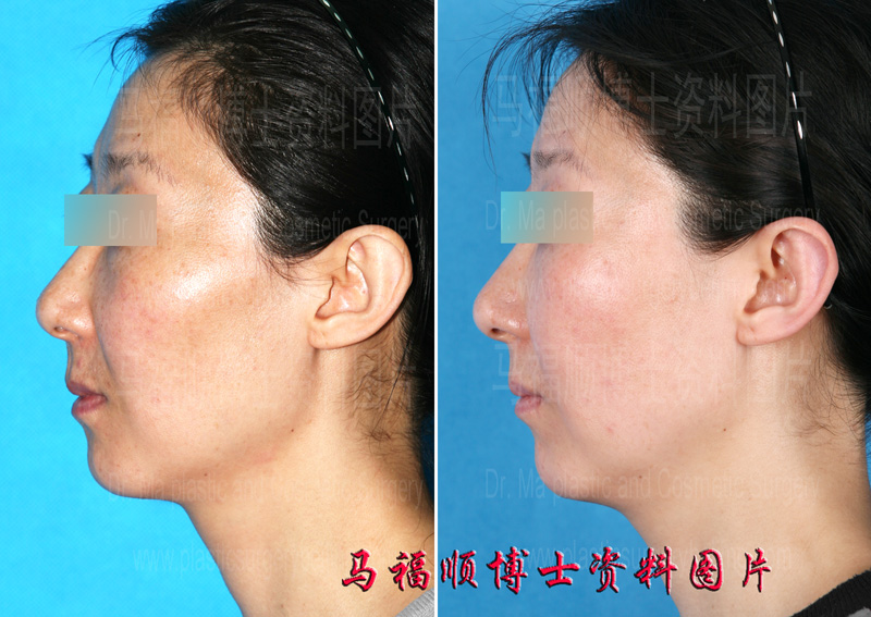 颧骨颧弓舒平术侧位