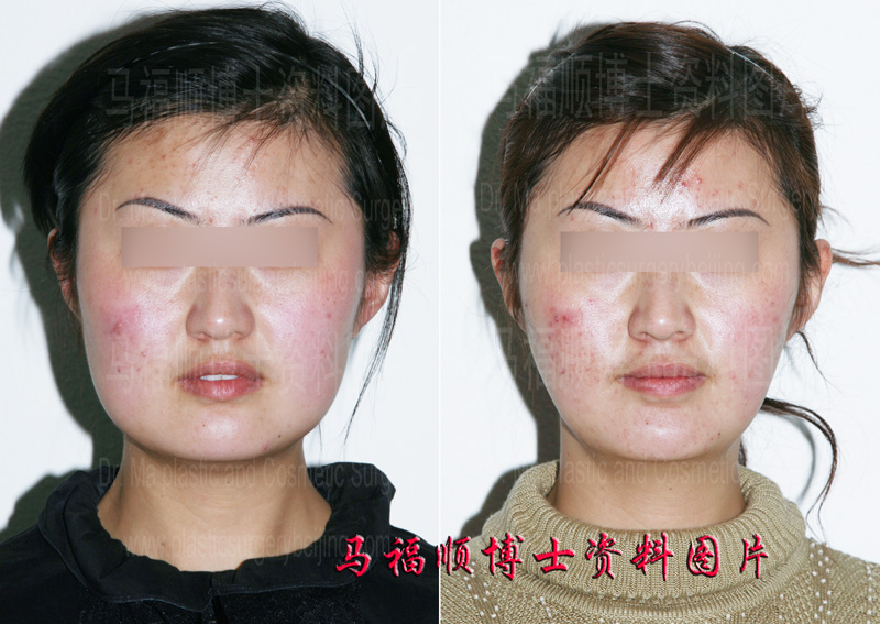 颧骨颧弓整形大脸变小脸