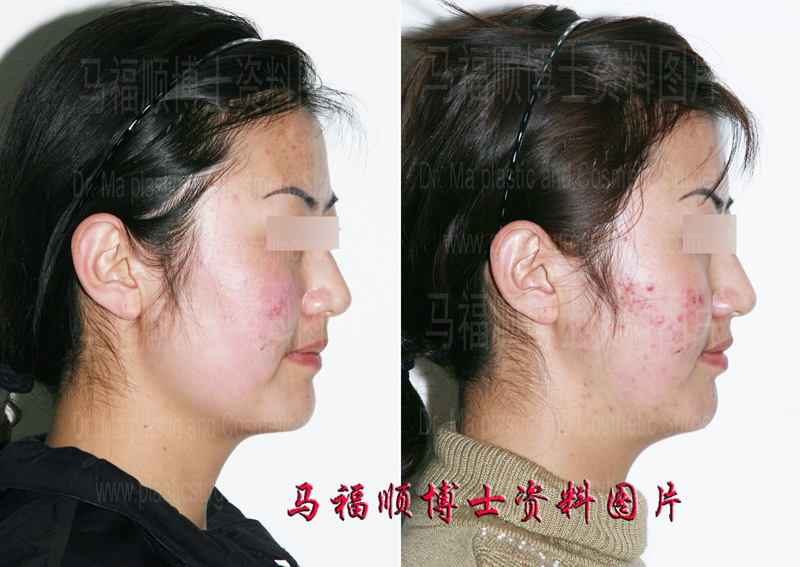 颧骨整形大脸变小