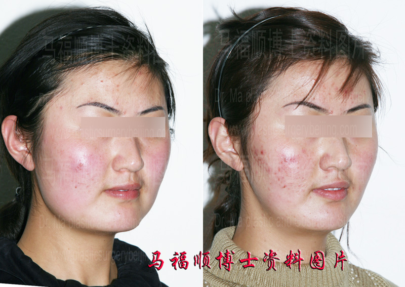 大脸变小脸整形术